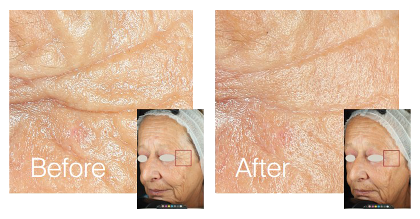 1. Wrinkles