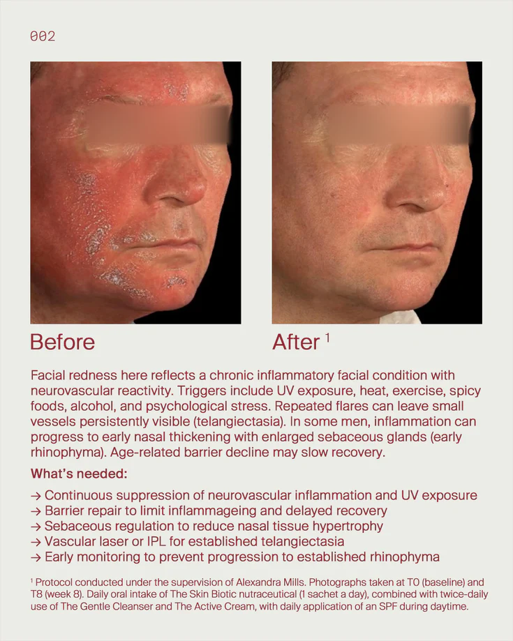 1. Facial redness