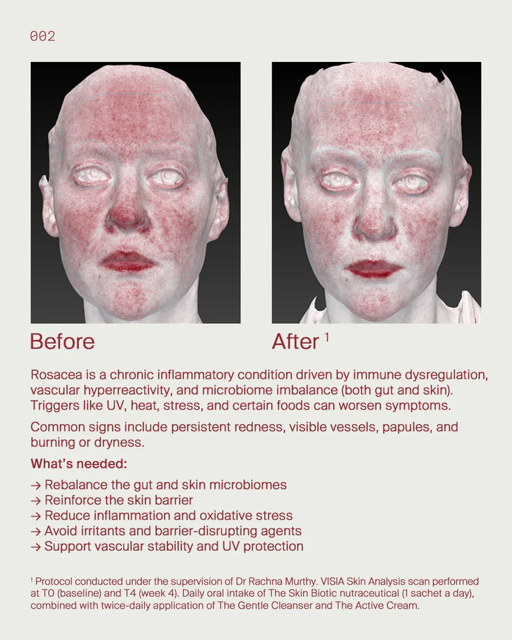 1. Rosacea