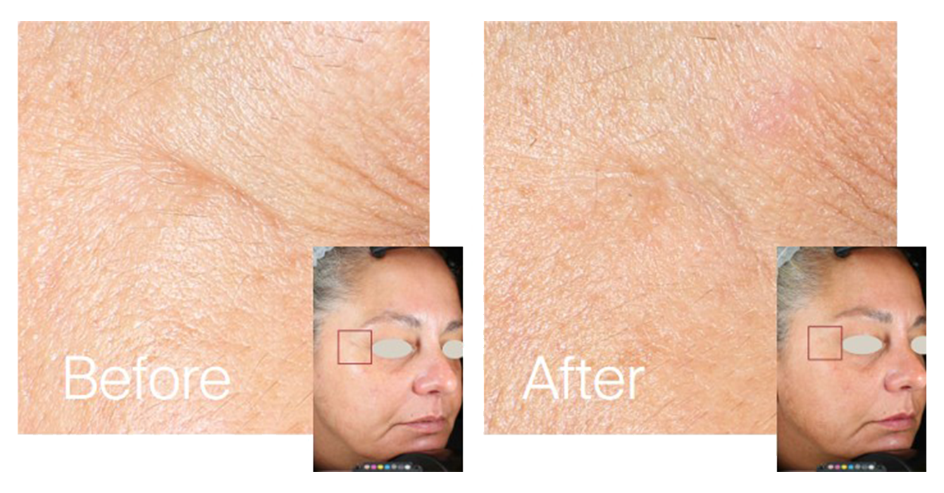 2. Fine lines