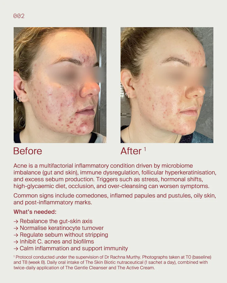 2. Acne