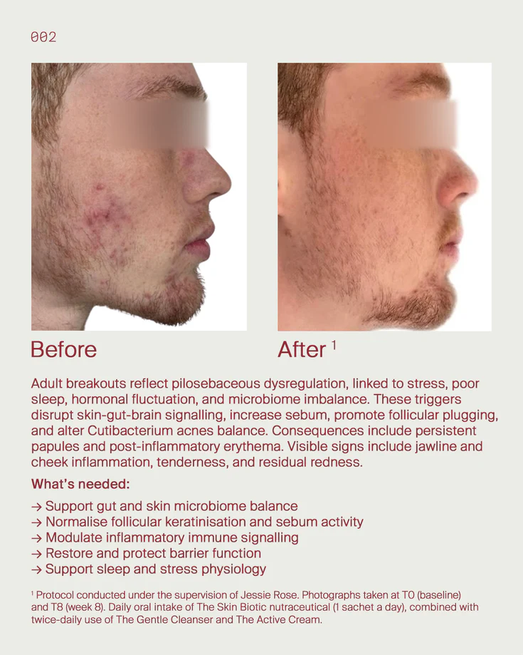 2. Adult acne