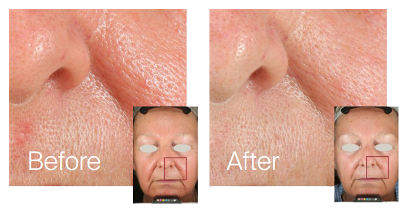 3. Moisturisation