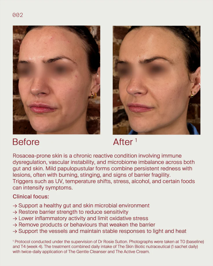 3. Rosacea prone