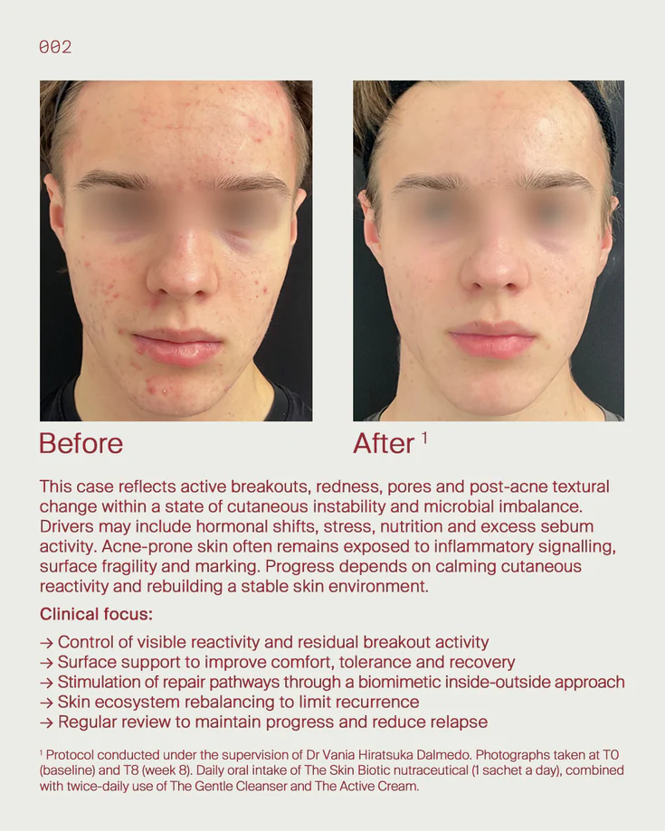 4. Acne prone