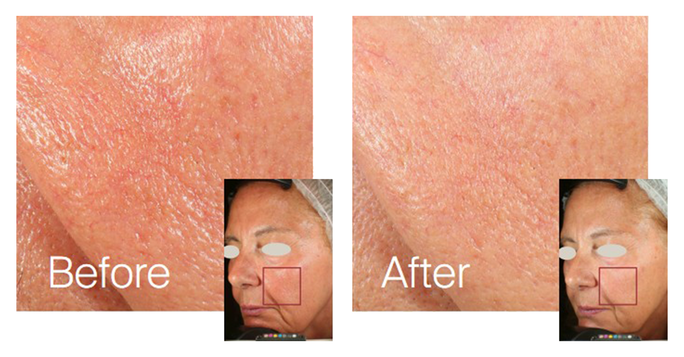 5. Skin barrier