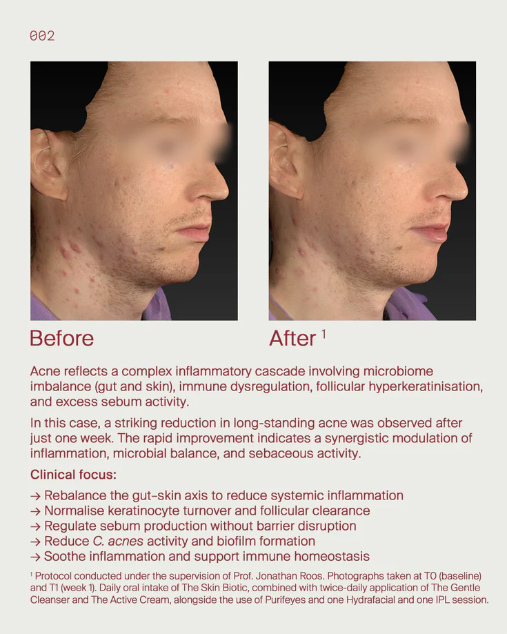 5. Chronic acne
