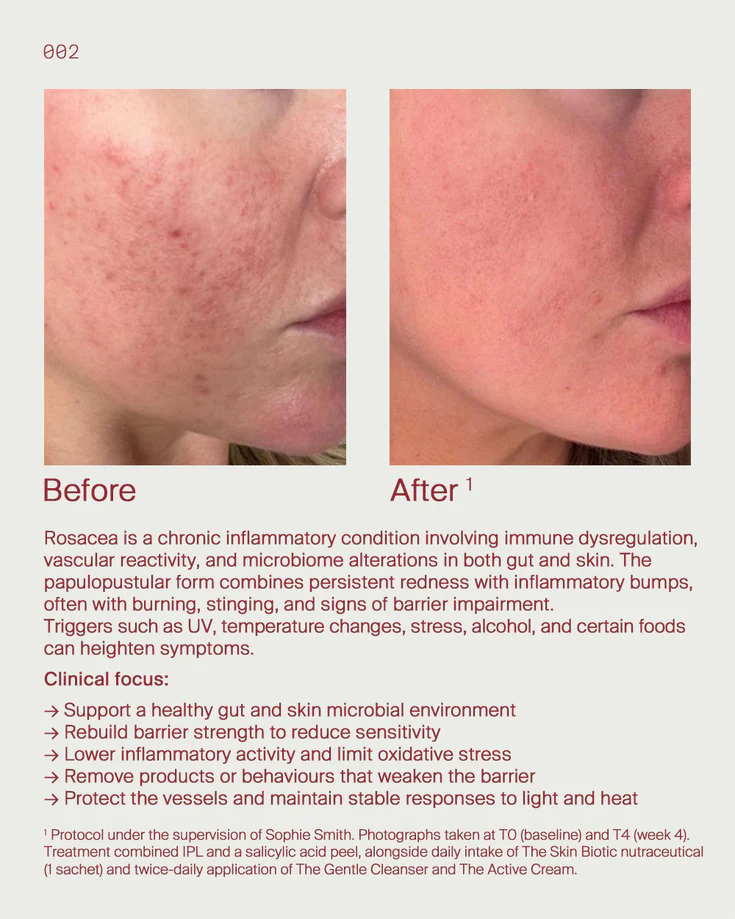 7. Rosacea