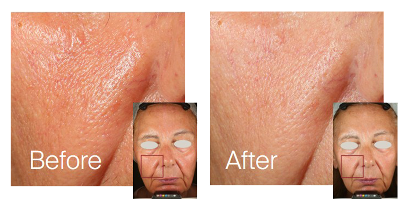 8. Sebum