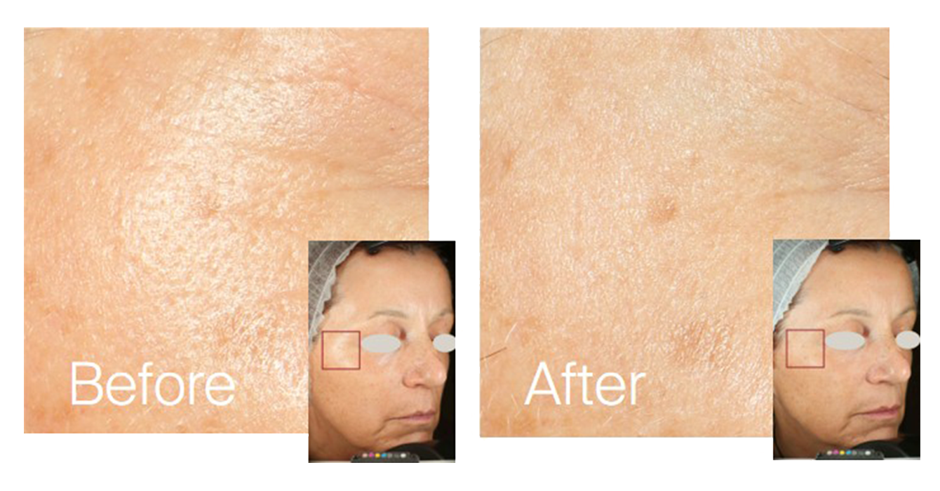 9. Pores
