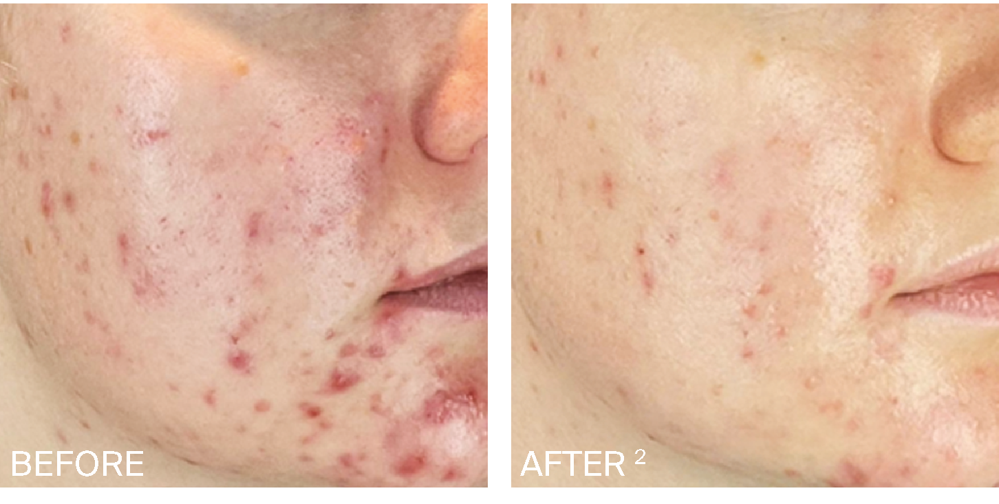 Acne Before After