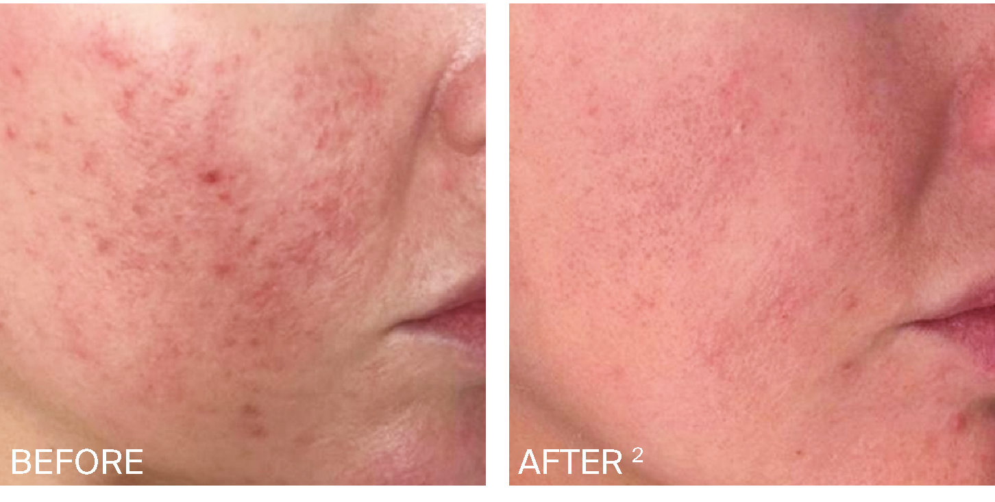 Rosacea Before After