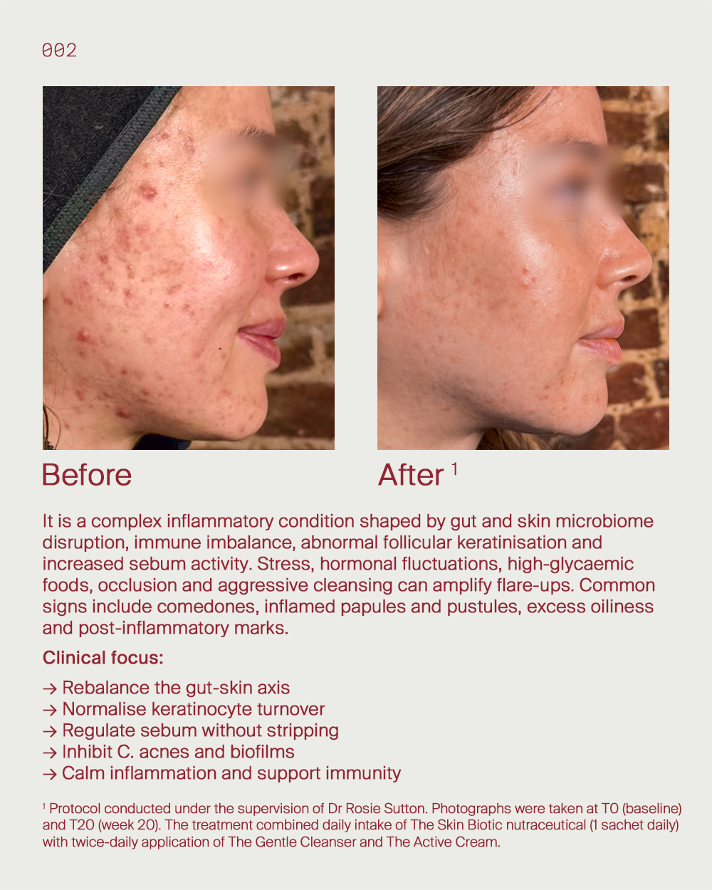 2. Acne reset